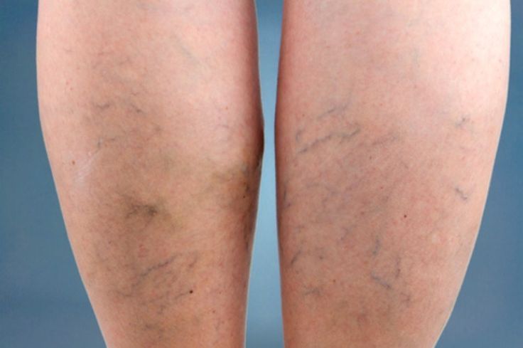 The Role of Swimming in Managing Varicose Veins